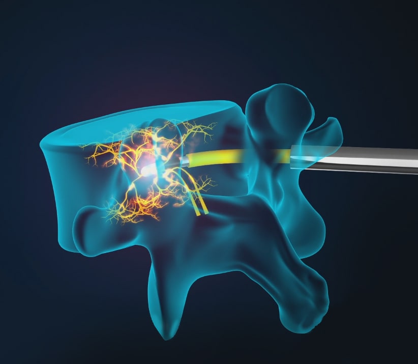 Intracept - Basivertebral Nerve Ablation